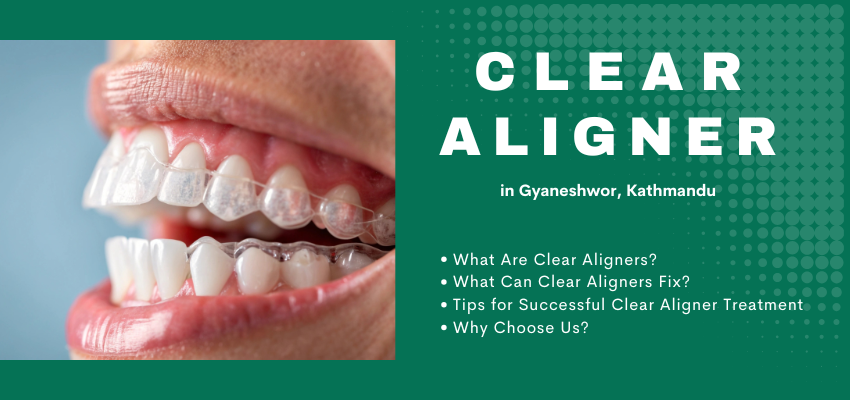 Clear Aligners Treatment