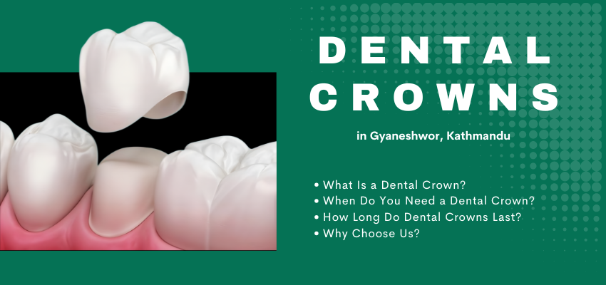Dental Crowns at D'Smile Dental Clinic in Gyaneshwor, Kathmandu