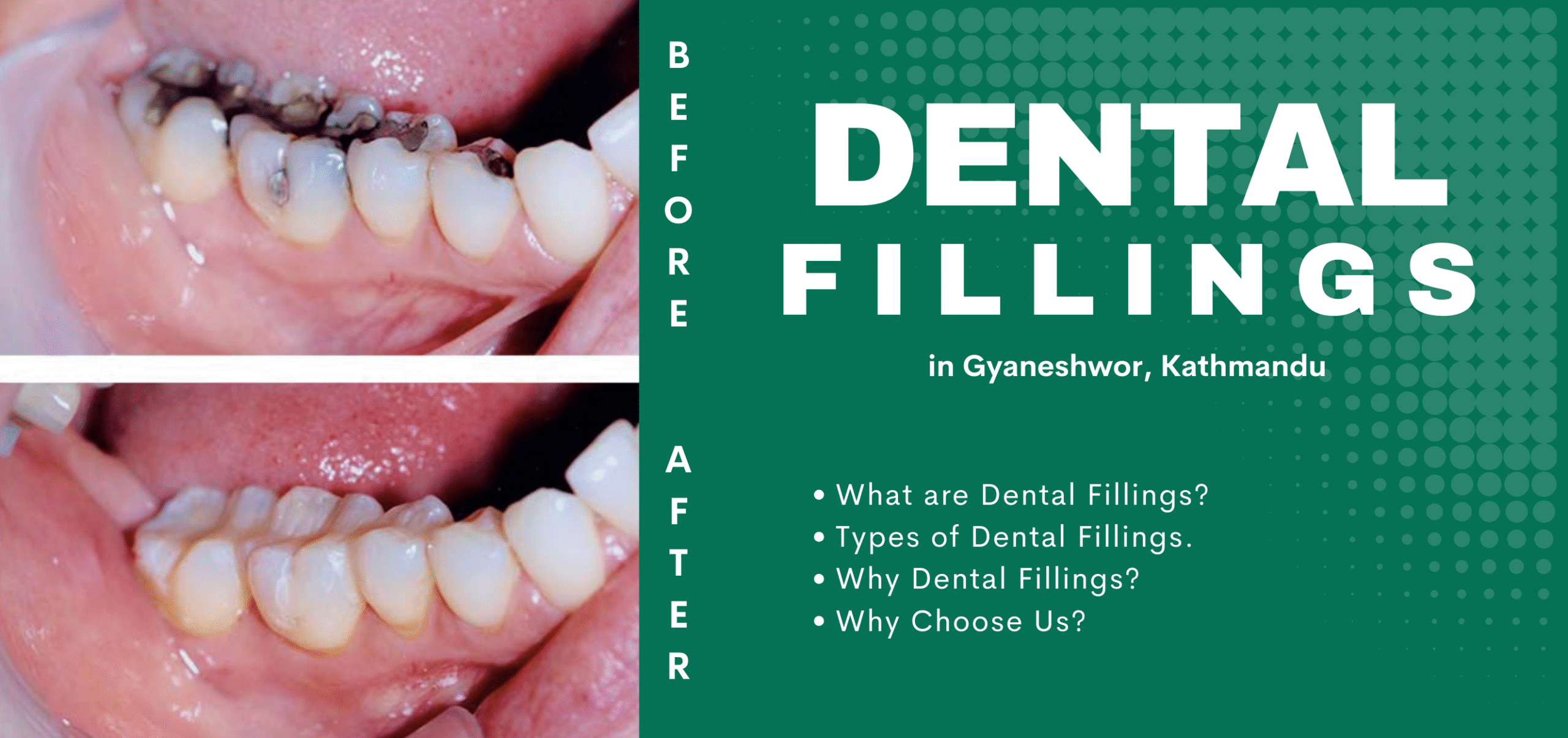 Dental Fillings Procedure