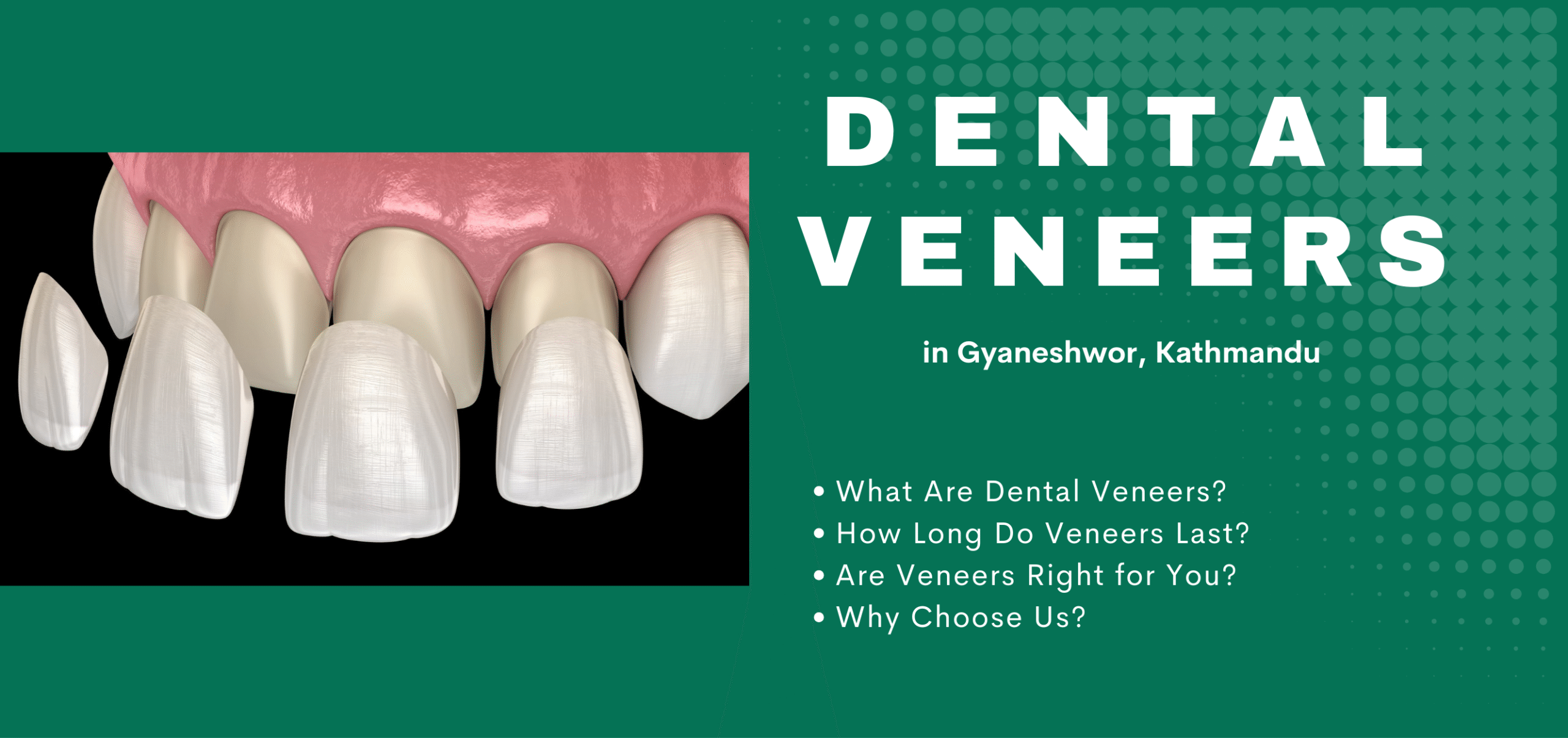 Dental Veneers Before and After