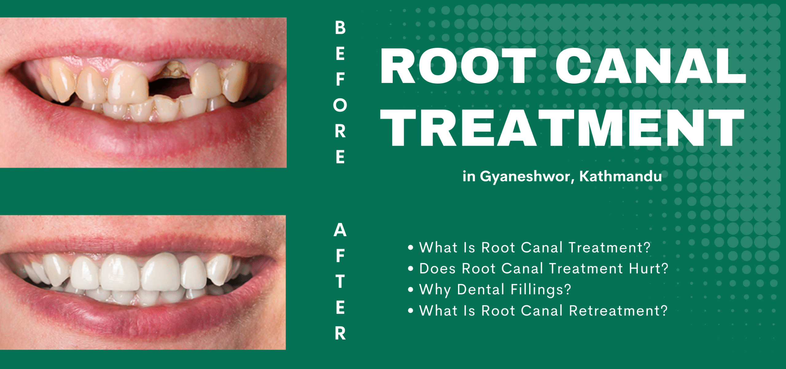 Root Canal Treatment Procedure