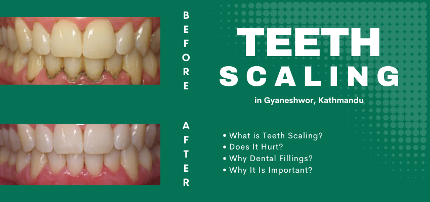 Teeth Scaling and Cleaning Procedure