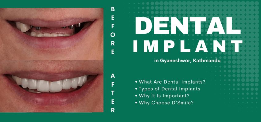 Dental Implant Procedure