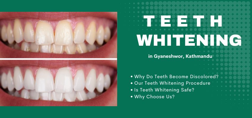 Teeth Whitening Before and After